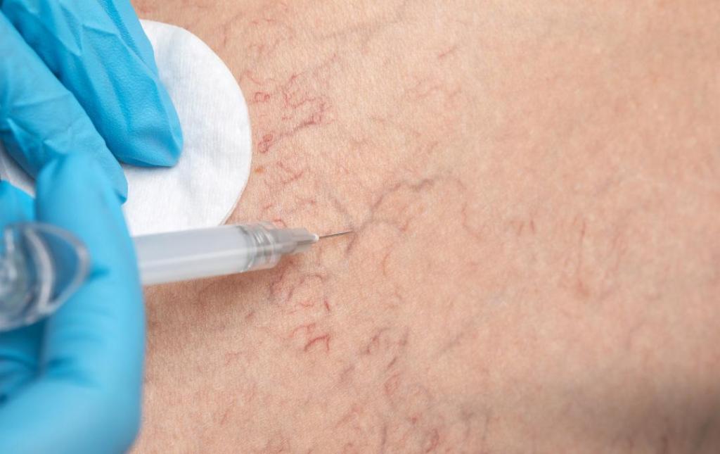 A Close Up of Spider Veins