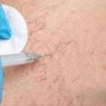 A Close Up of Spider Veins