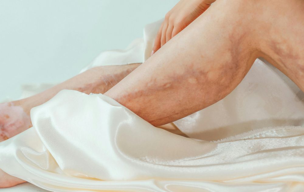 Vein Discoloration