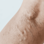 Dehydrated Veins
