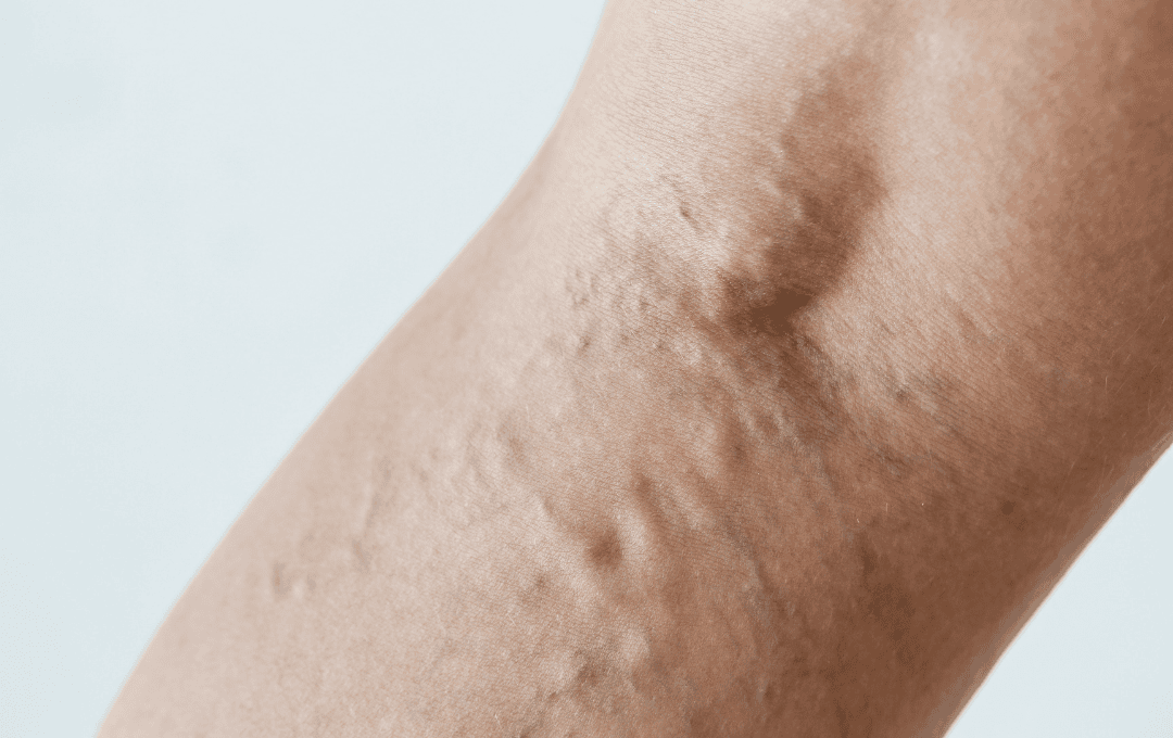 Dehydrated Veins