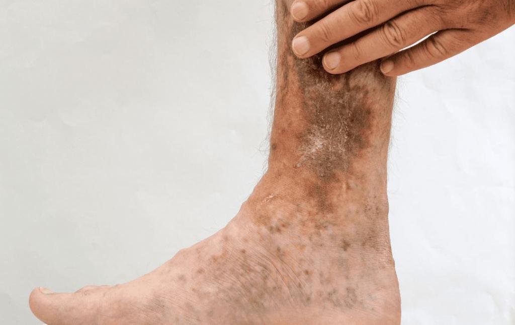 Brown Spots on Legs