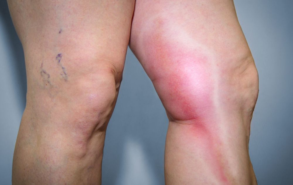 Patient showing leg with visible varicose veins, showing relief from phlebitis inflammation after vein treatment.