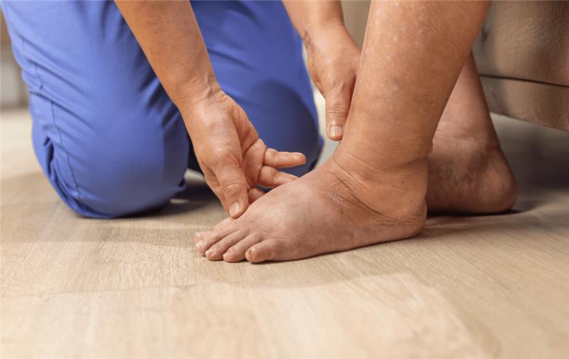 How to get rid of lymphedema in legs