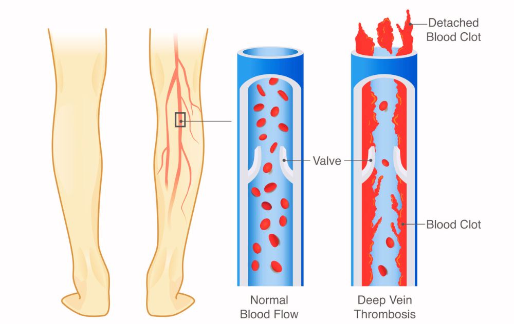 Slate Dvt Example Is Vein Disease Life-Threatening? | Vein Resource Center