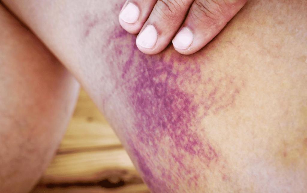 Bruising on the leg caused by vein issues