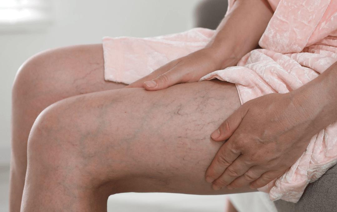 Knowing important veins in your legs can help you avoid vein disease