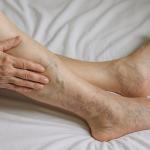 Person looking at legs and wondering if vein disease is life-threatening?