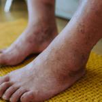 Legs showing Early Signs of May-Thurner Syndrome