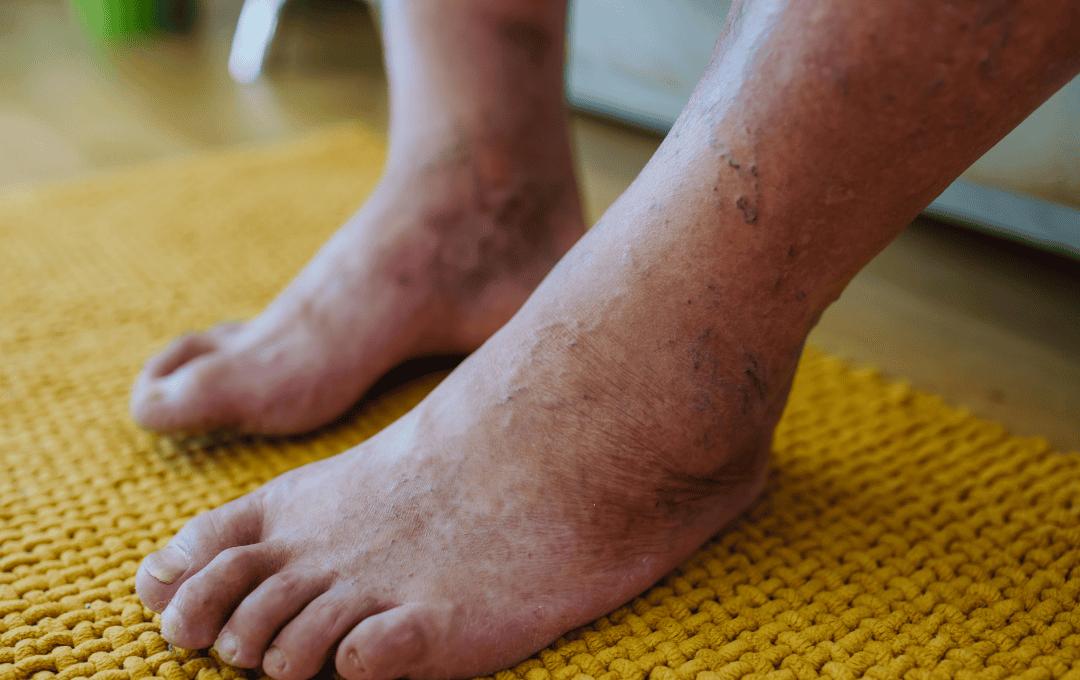 Legs showing Early Signs of May-Thurner Syndrome