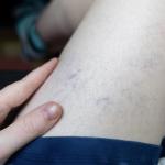 Venous Stasis vs. Varicose Veins: What’s the Difference? 2 Learning the difference between Venous Stasis and Varicose Veins can determine what will treat your condition best