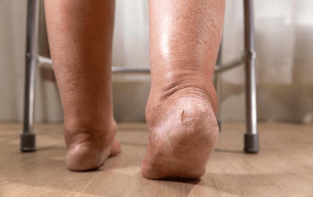 Swelling below the knee, which can be caused by a variety of factors