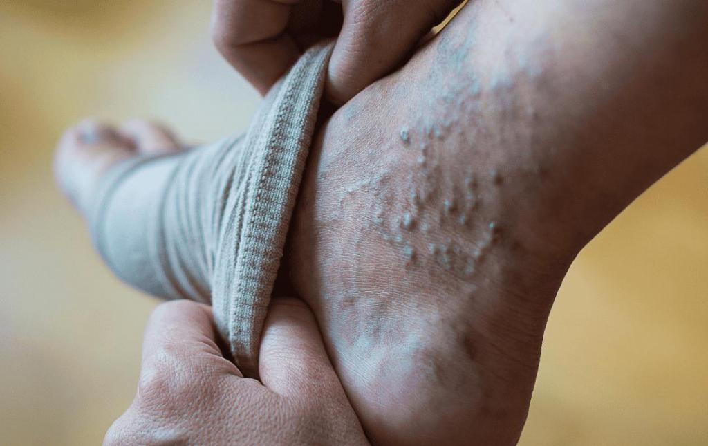 Varicose Veins on Feet, one of the several locations the can appear