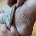 Varicose Veins on Feet, one of the several locations the can appear