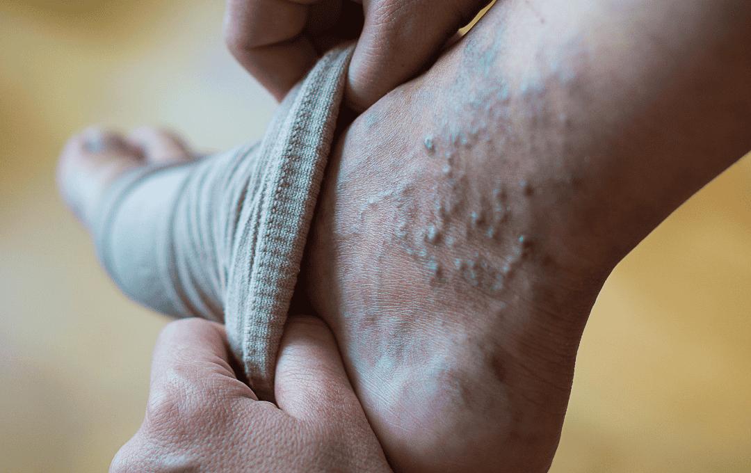 Varicose Veins on Feet, one of the several locations the can appear