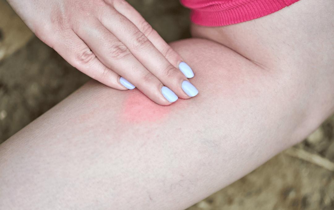 What might seem like small symptoms can be indicators of Chronic Venous Insufficiency