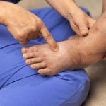 Swelling of the ankles can be a sign of various vein issues