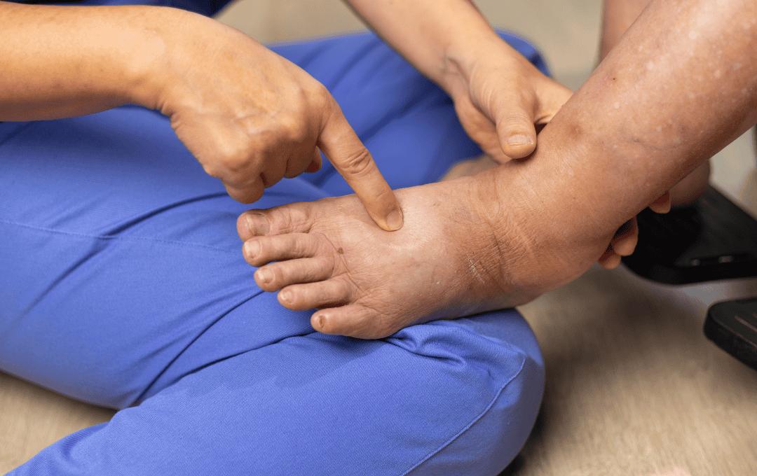 Swelling of the ankles can be a sign of various vein issues