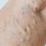 Why Do My Varicose Veins Feel Warm? 5 Warm Varicose Veins can be an indicator for deeper vein issues