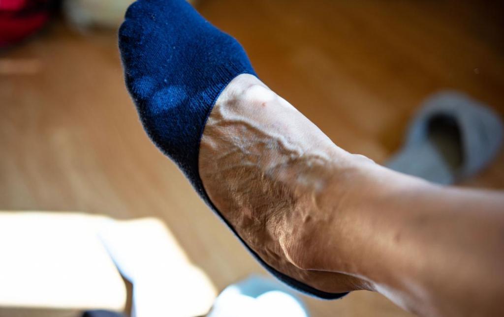 Are Varicose Vein Treatments Permanent? 4 Are varicose veins permanent? The answer is more than a yes or a no.