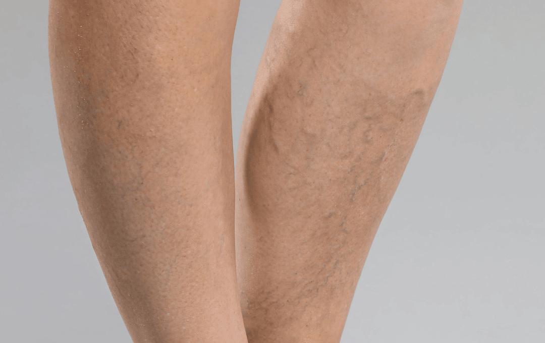 What Causes Leg Aches in Older Adults? 1 Learn more about the impact aging has on your leg health.